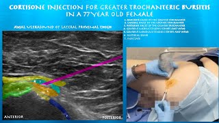 Ultrasound Guided Greater Trochanteric Bursitis Injection By Probeultrasound