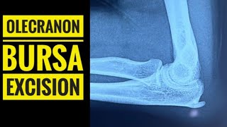 Excision Of Olecranon Bursa And Spur