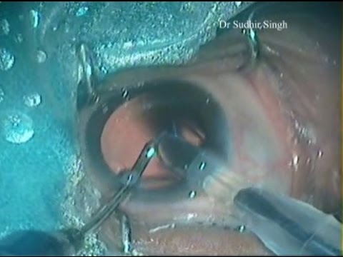 Phaco With Hydro Implantation Of Hydrophobic Foldable Iol By Dr Sudhir Singh Youtube