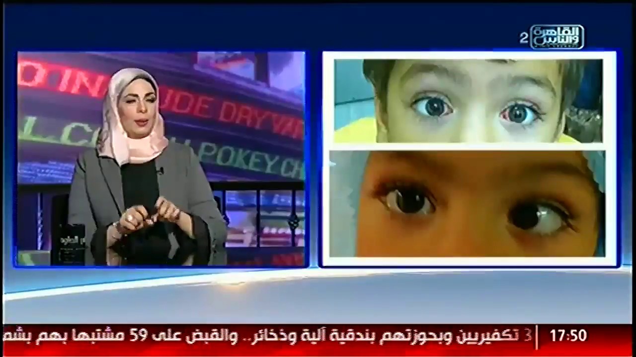 احدث طرق علاج الحول و الفرق بين الحول عند الاطفال و الكبار.  د هبة متولى