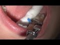 Tooth filling