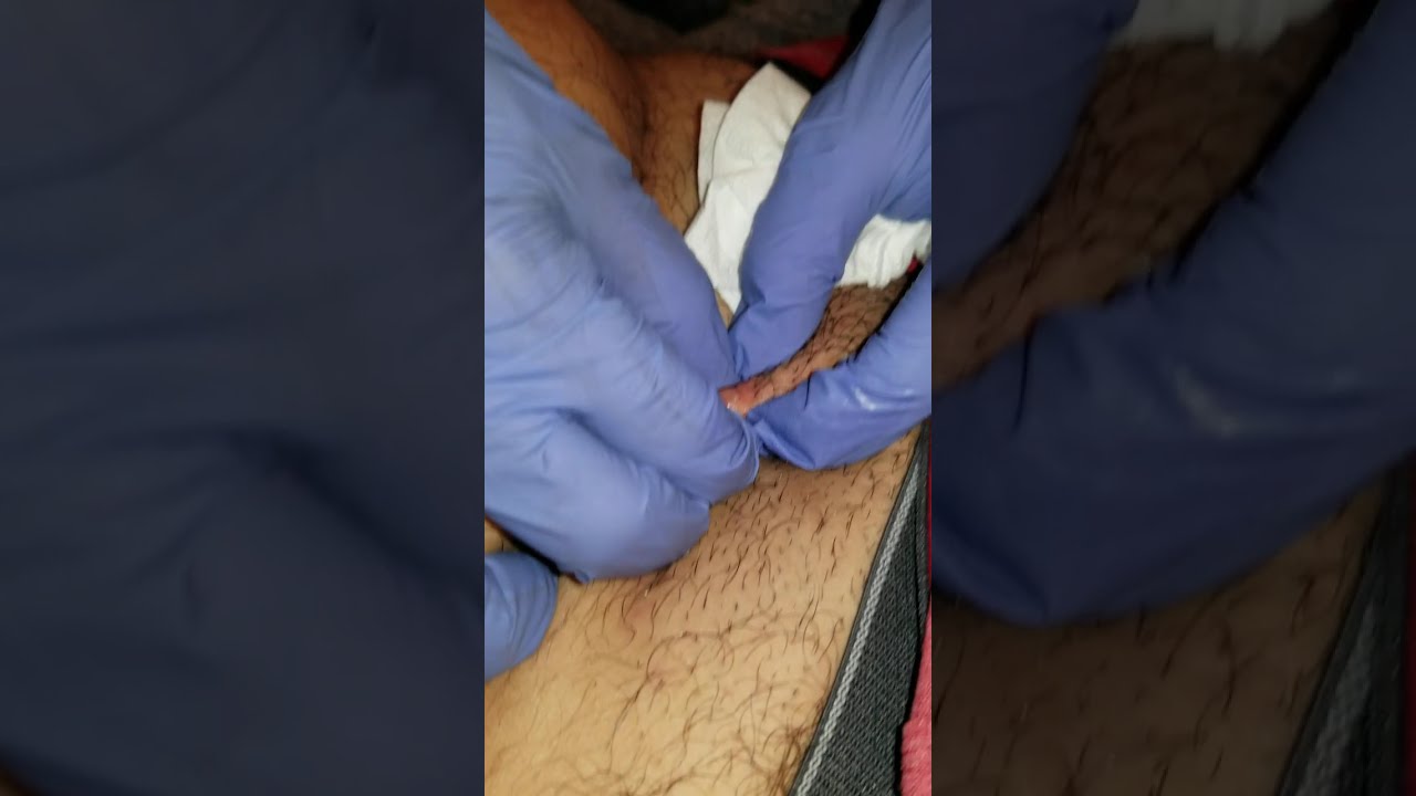 Ingrown Hair Explosion Groin Youtube