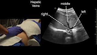 Transverse Liver Scan Technique