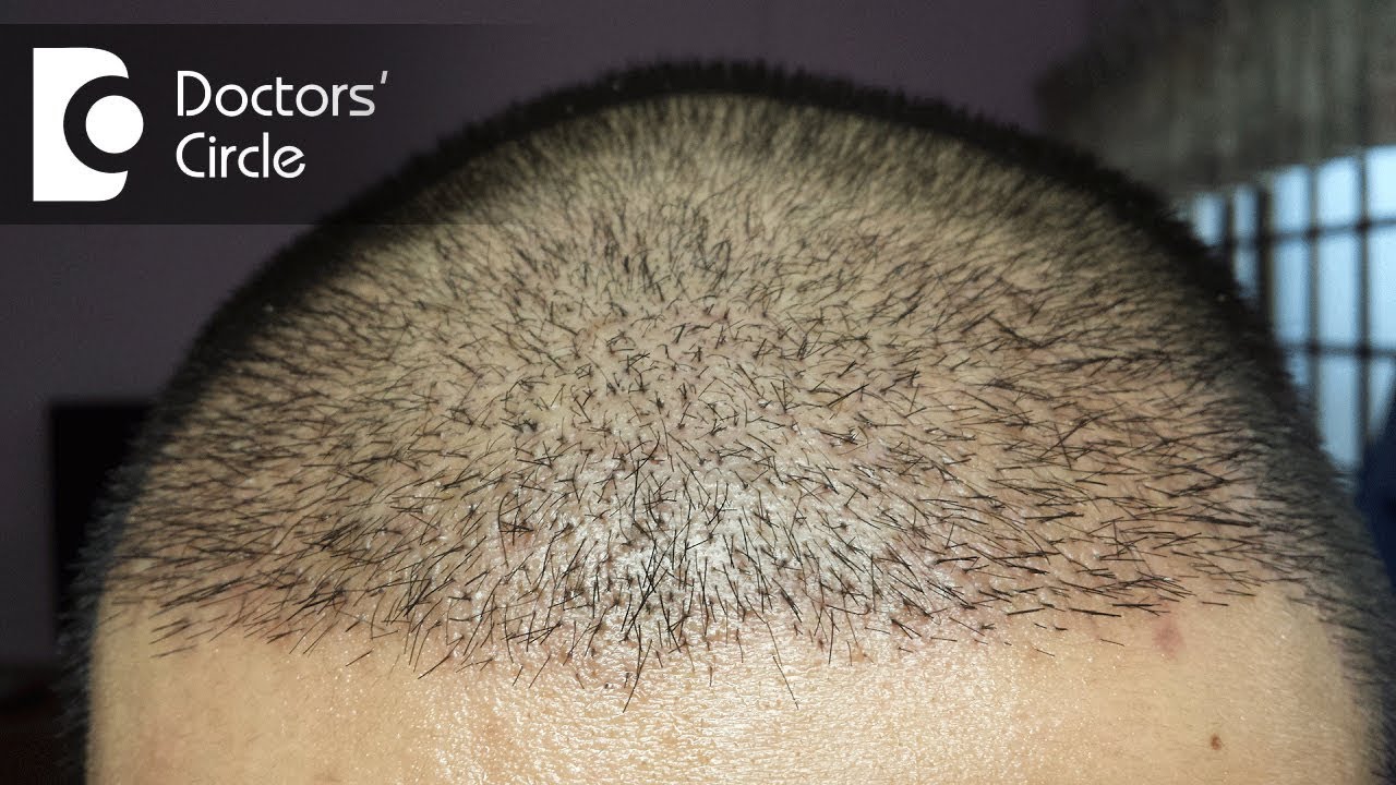 How long does it take for hair to grow after a hair transplant? - Dr. Madan  Kumar BJ - YouTube