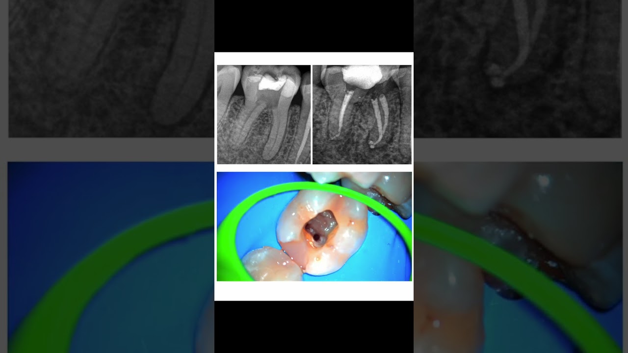 Cómo manejar conductos estrechos