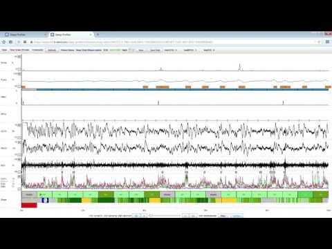 Sleep Profiler: Application and editing of sleep staging