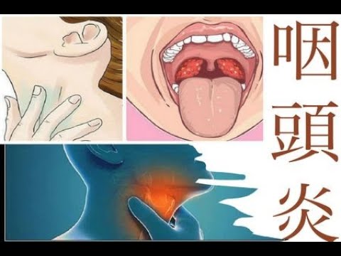 [健康] 咽頭炎とは？概念・原因・治療・予防について #4