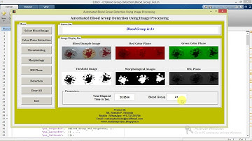 Identification of Blood Type Using Matlab | With Source Code | Blood Group Finding Maltab Code