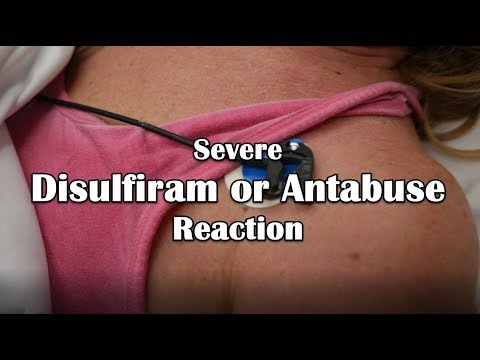 Disulfiram or Antabuse Reaction Emergency