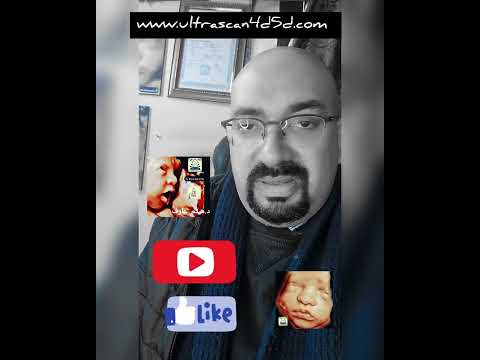 لو حامل و خايفه من متلازمه داون لازم تشوفي الفيديو ده