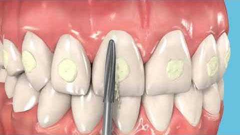 Frank dental Orthodontic debonding bur - Adhesive remover bur - 22ALGK