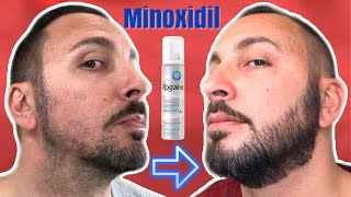 HOW TO GROW A REAL BEARD - Minoxidil 8 Month Update