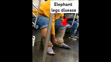 Lymphatic Filariasis