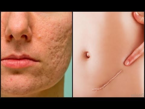 Reduce Cicatrices Antiguas como Recientes. Queloides, Acne, Varicela, Quemaduras... /DIY MEDERMA