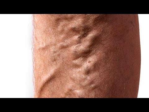 Varicose veins – معلومات صحية عن الدوالي الوريدية – فيديو توضيحي من موقع دكتوري