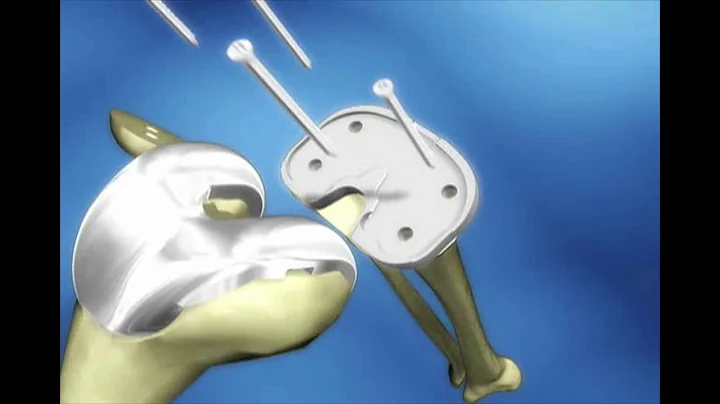Knee Replacement Surgery - Minimally Invasive Surg...