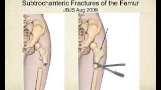 Proximal femur fractures:  how to identify and avoid malreduction malrotation