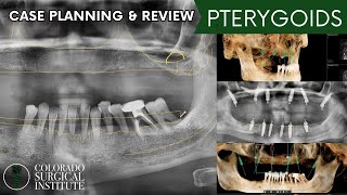 Double Arch Dental Implants Surgery Case Planning and Review: Pterygoids Start to Finish