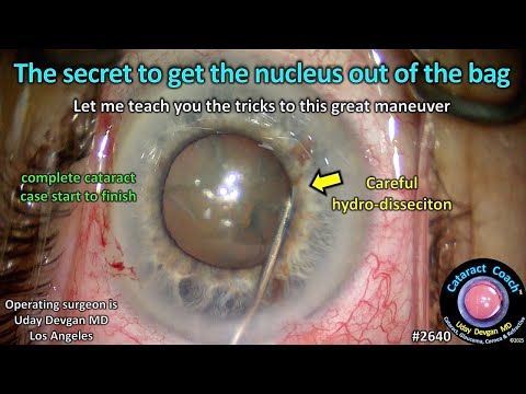 CataractCoach™ 2640: the secret to get the nucleus out of bag