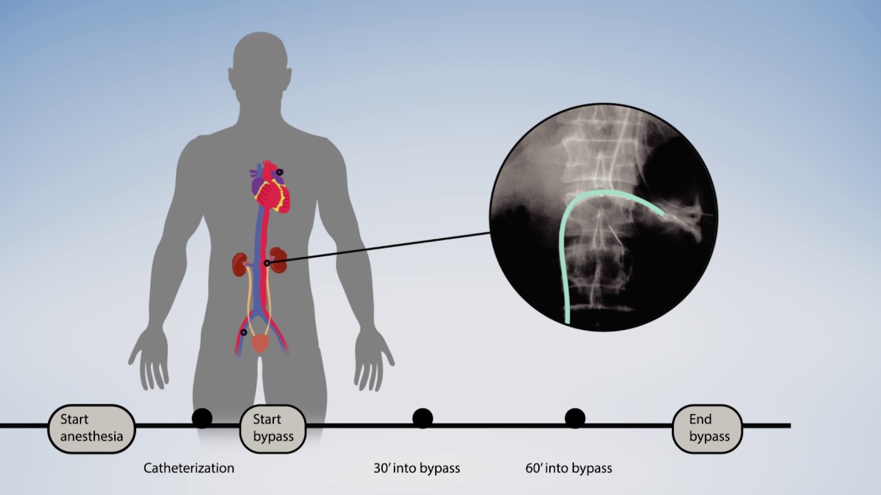 Heart Lung Machine Diagram