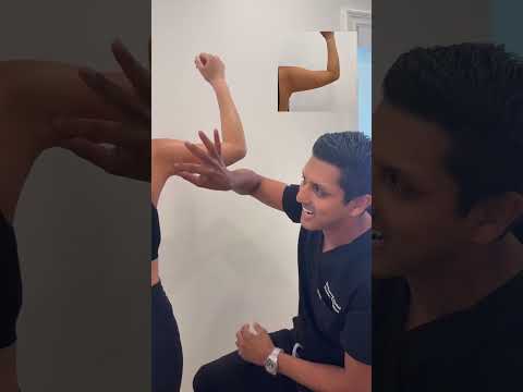 6 Weeks After Arm Lipo Sculpting with Renuvion: Sleek, Defined Results