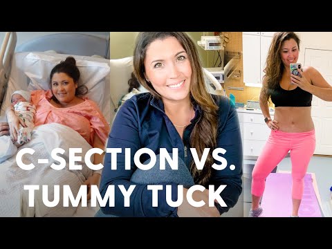 Video: Tummy Tuck Setelah C-Section: Is It Safe?