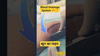 Blood Drainage System💥💥 ऑपरेशन के बाद जमे खुन्नको निकालना #drainagesystem #drainagepipe #fracture