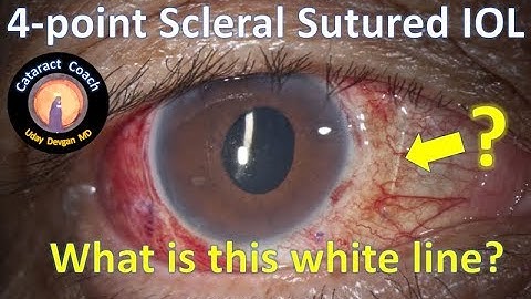 Four-Point Scleral Fixation of an IOL using Gore-Tex - Cataract Coach