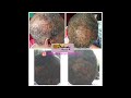 Medical  and Hormonal Hair loss and the Time it Takes To Heal (BlackHairandSkincare.com)