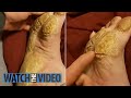 Removing Extremely Hard Foot Callus 🦶 The right way to remove foot callus FULL TREATMENT #08