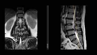 VERTEBRA TRANSICIONAL LUMBOSACRA  EN RM : LUMBARIZACION DE S1 VS SACRALIZACION L5