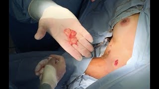 Sebaceous fat cyst (wen) surgery removal.