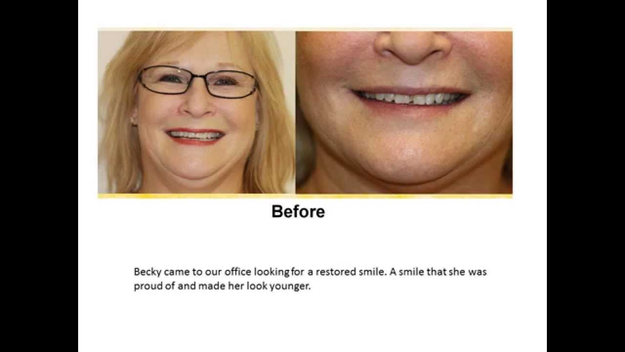 Dental Crowns Before and After - YouTube