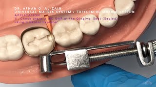 Universal (Tofflemire) matrix system (2) application & removal overview  Arabic عربي