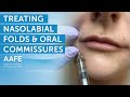 Using Dermal Fillers to Fill and Smooth Smile Lines! | AAFE