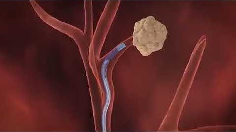 Electromagnetic Navigation Bronchoscopy™ Procedure Video