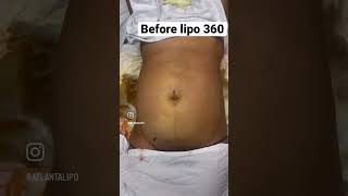 Lipo 360 Before And After Performed By Dr. Cole