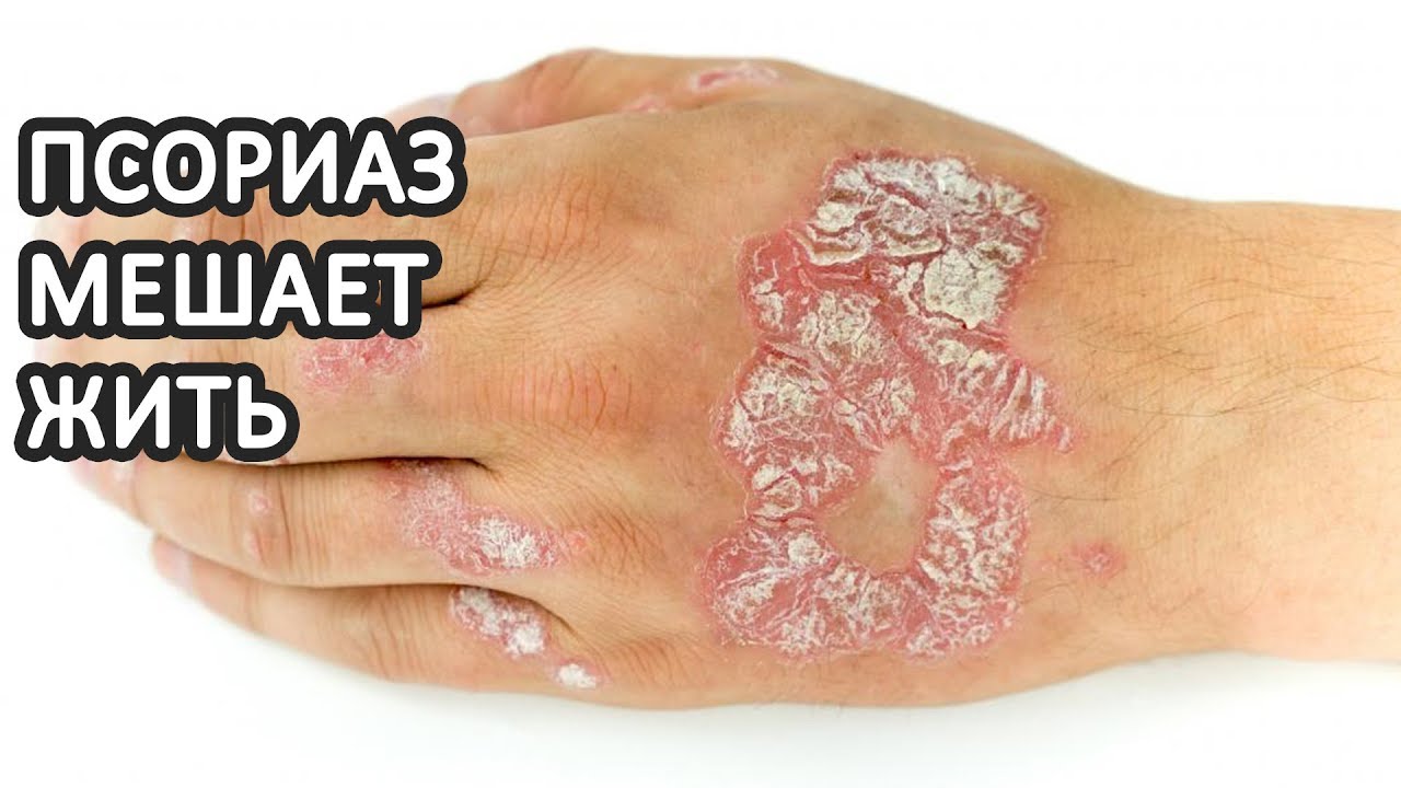 Псориаз как причина депрессии. Что делать?