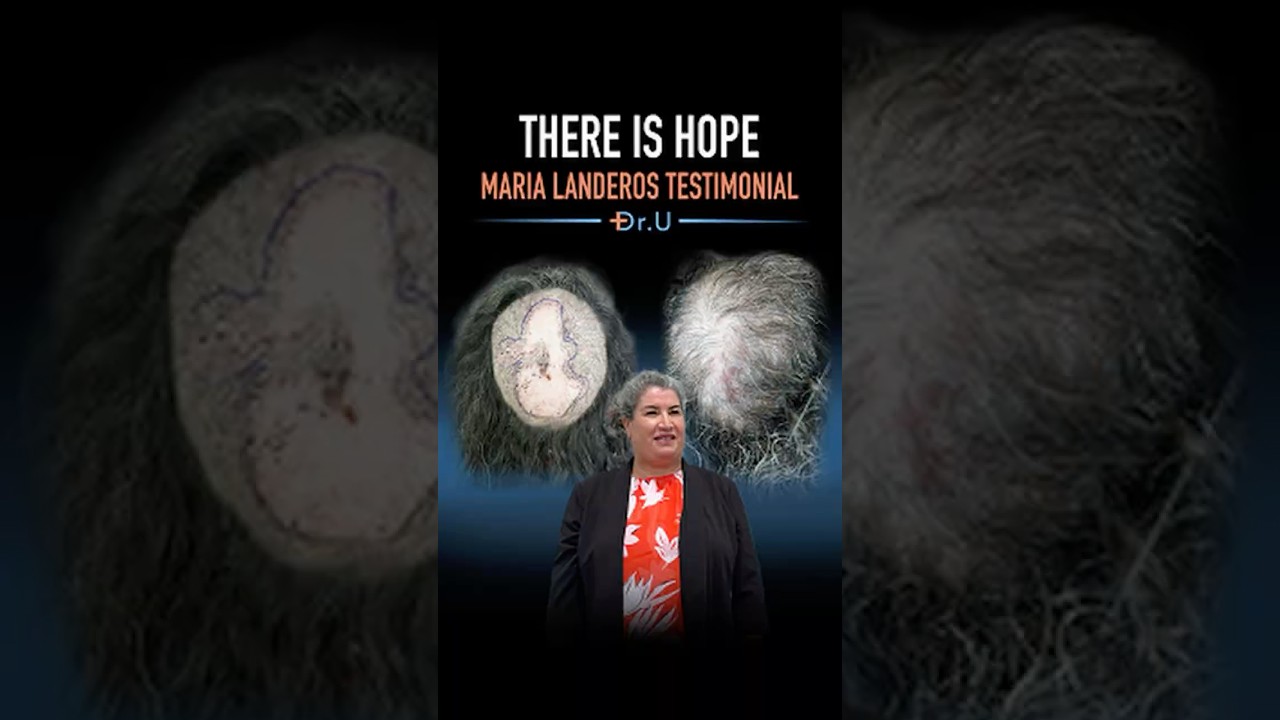 There Is Hope | Maria's Scarring Alopecia Testimonial