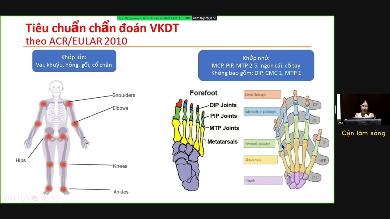 Cập nhật những tiến bộ trong chẩn đoán và điều trị viêm khớp dạng thấp | ThS. BS. Trần Hồng Thụy