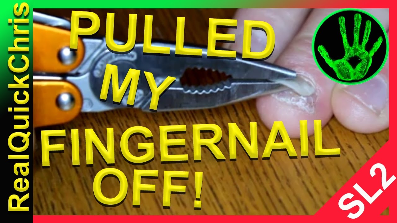 pulled my finger nail off after I smashed my finger YouTube