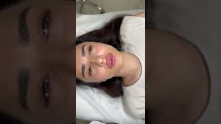 Контурная пластика губ👄