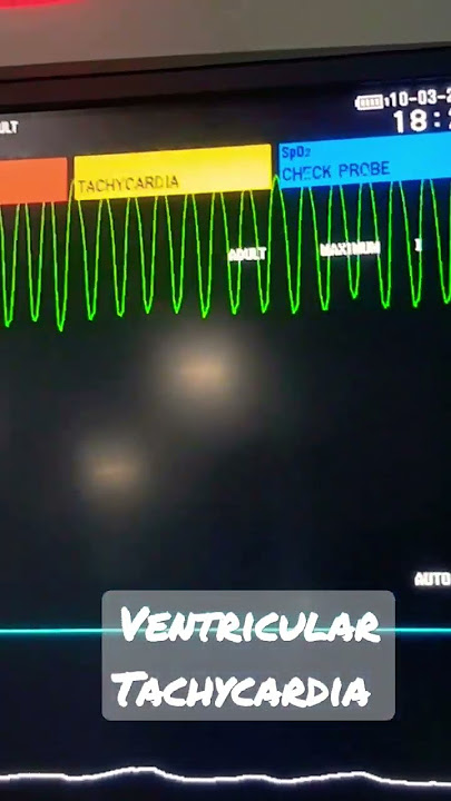 Ventricular Tachycardia  #medicine #ekg #meditation #foryou