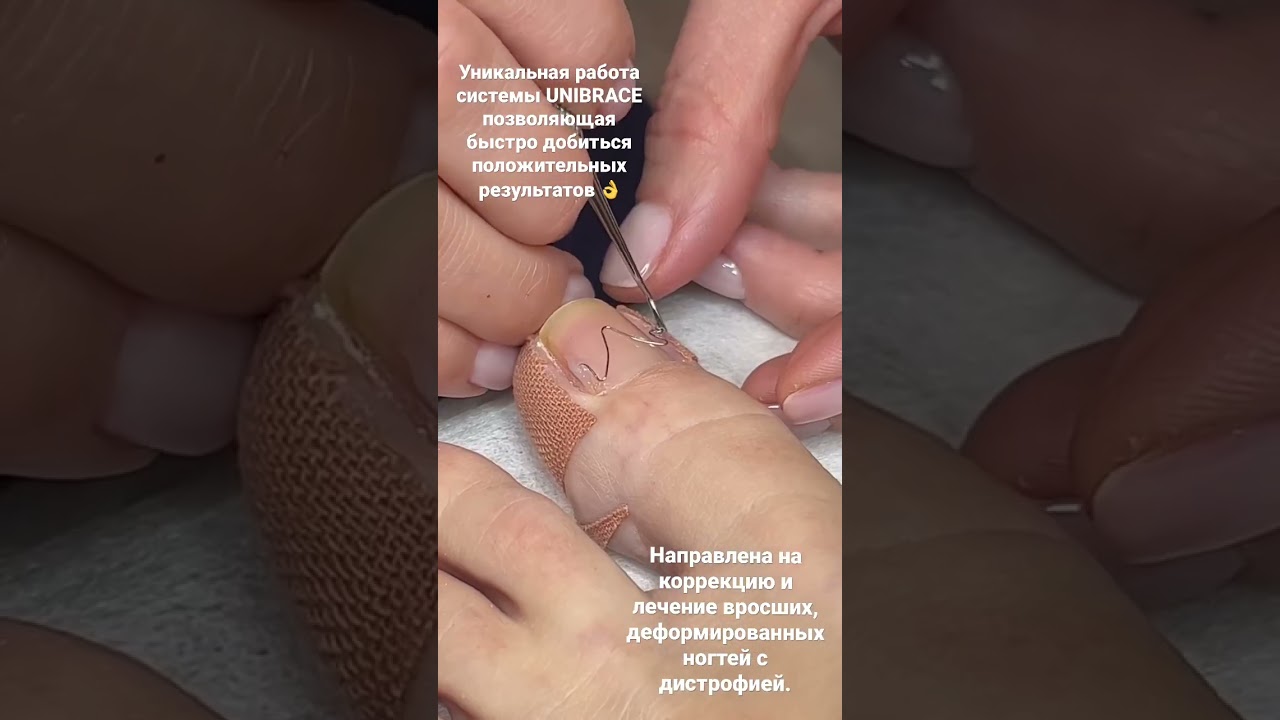 UNIBRACE - универсальная корректирующая система , направлена на восстановление вросших ногтей.