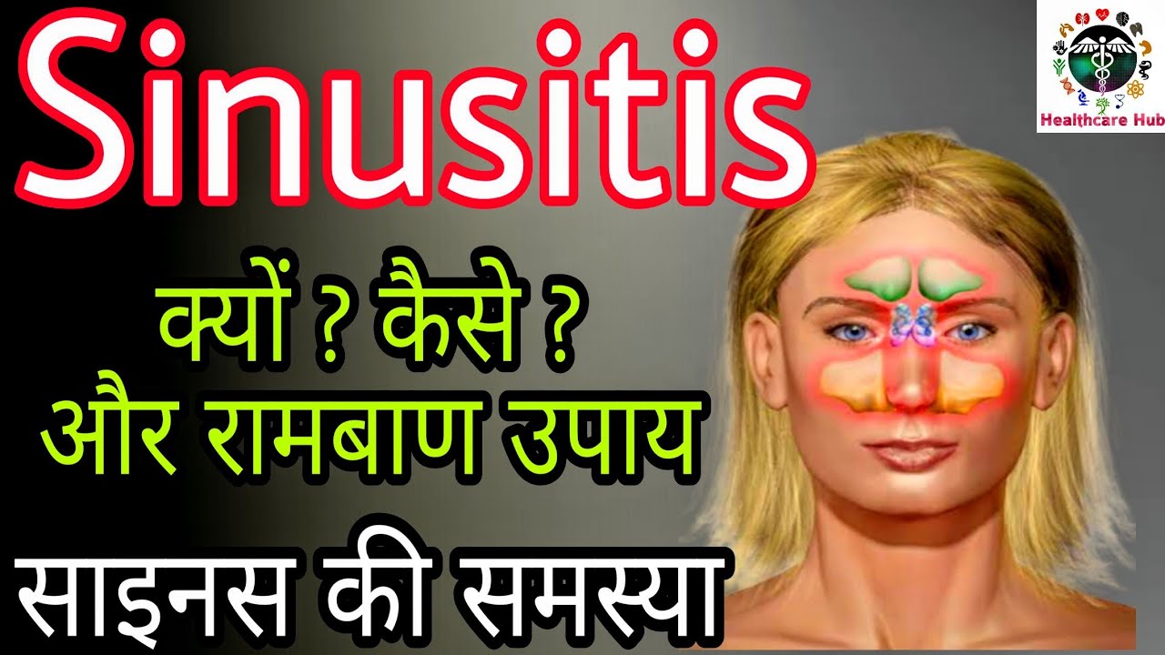 Sinusitis Sinus Home Remedies Sinus ki samasya साइनस के घरेलू उपचार YouTube