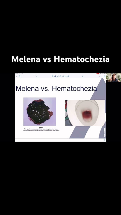 Melena vs Hematochezia #podcast #asianamerican #healthpolicy