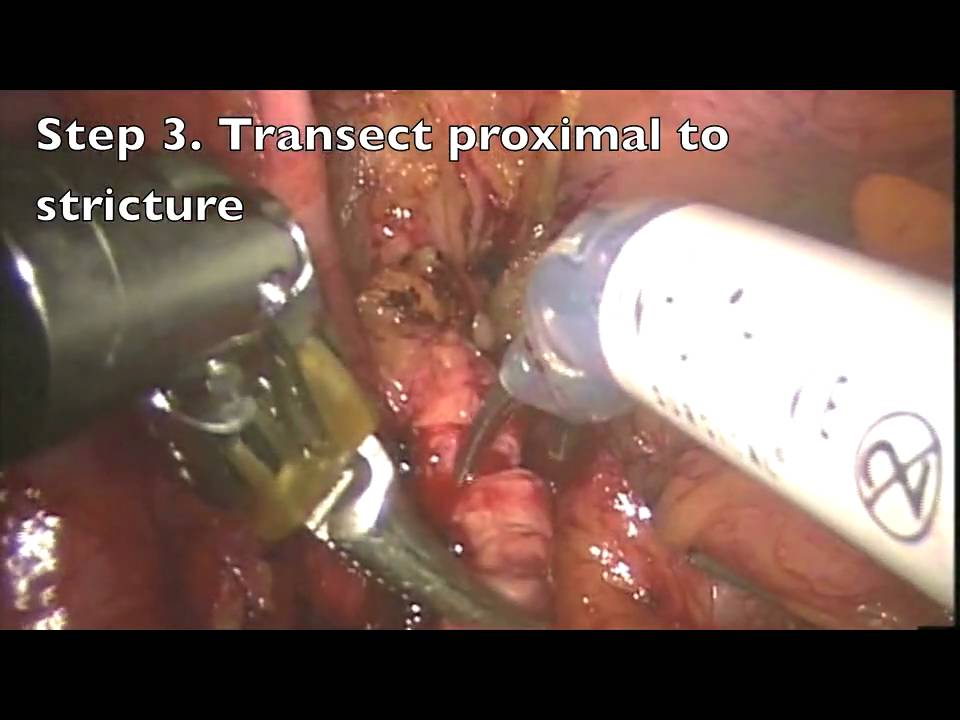 Robotic Ureteral Reimplant Psoas Hitch camera iphone 8 plus apk
