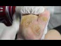 Ep_2323 Foot nails skin removal 👣 วิธีขูดหนังด้านให้เนียน  😷 (This clip is from Thailand)