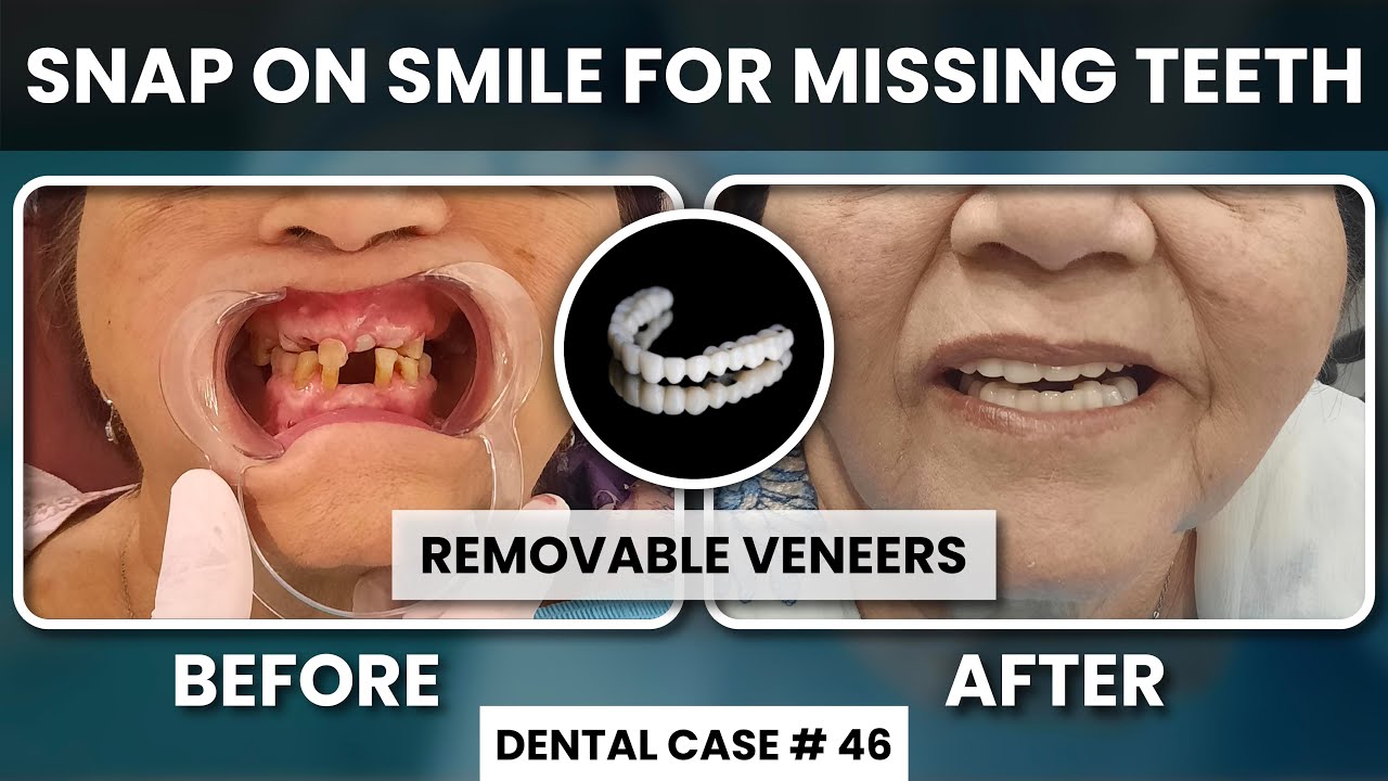 Snap On Smile For Missing Teeth | Before And After | Removable Veneers Teeth | Dental Case # 46