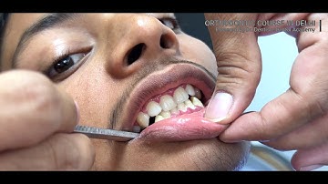 Class II Division 2 Malocclusion Treatment Guide by Dr. Kapil Saroha